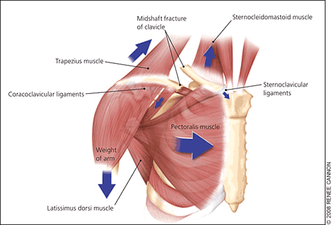 Clavicle Collar Bone Fracture Frisco Tx Knee Hip Shoulder Joint Surgery