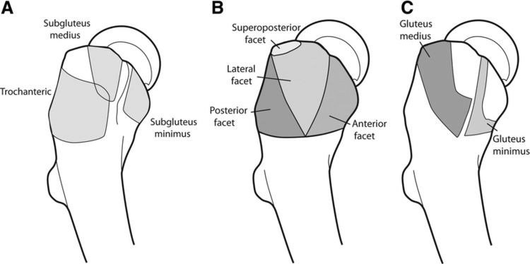 Gluteus Maximus Pain  What It Is, Pain Pattern, Symptoms, & Relief