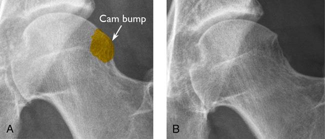 Hip Impingement / Femoroacetabular Impingement (FAI), Frisco, TX, Dr.  Andrew Dold, MD