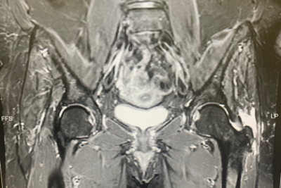 Gluteus Medius and Minimus Tears Frisco, TX Andrew Dold, MD