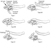 Clavicle (Collar Bone) Fracture - Frisco, TX - Knee, Hip, Shoulder ...