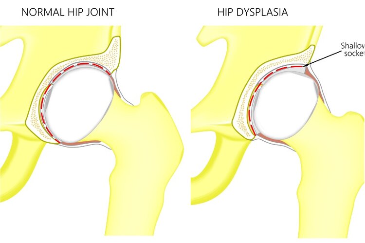 Hip Dysplasia Frisco TX Orthopedic Surgeon