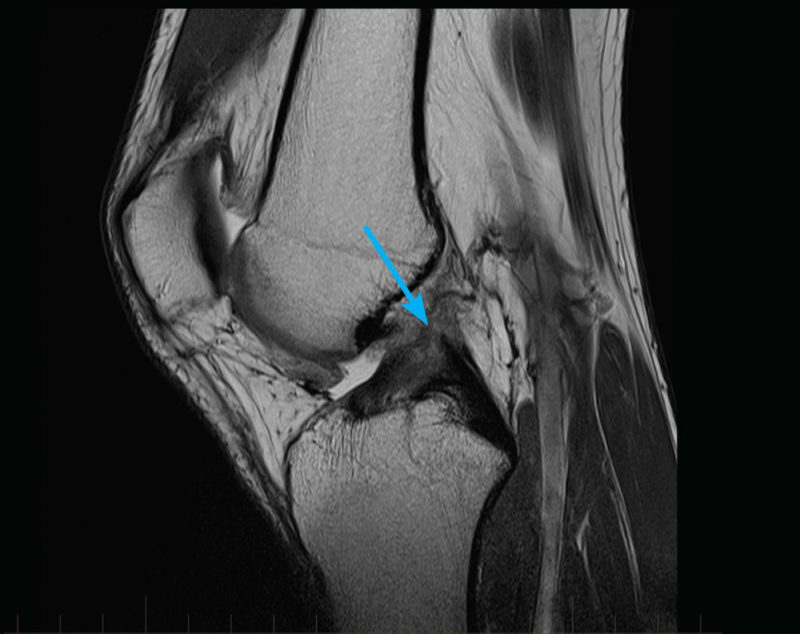 Knee Procedures - Frisco, TX - Knee, Hip, Shoulder, Joint Surgery