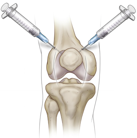 Viscosupplementation - Frisco, TX - Knee, Hip, Shoulder, Joint Surgery