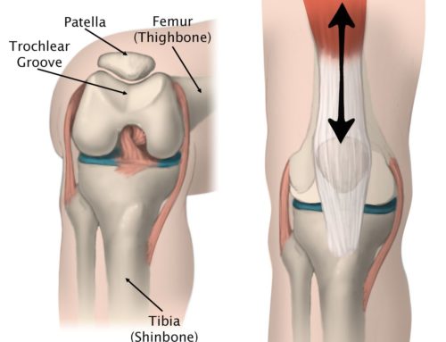What is Runner’s Knee? And how do I treat it?