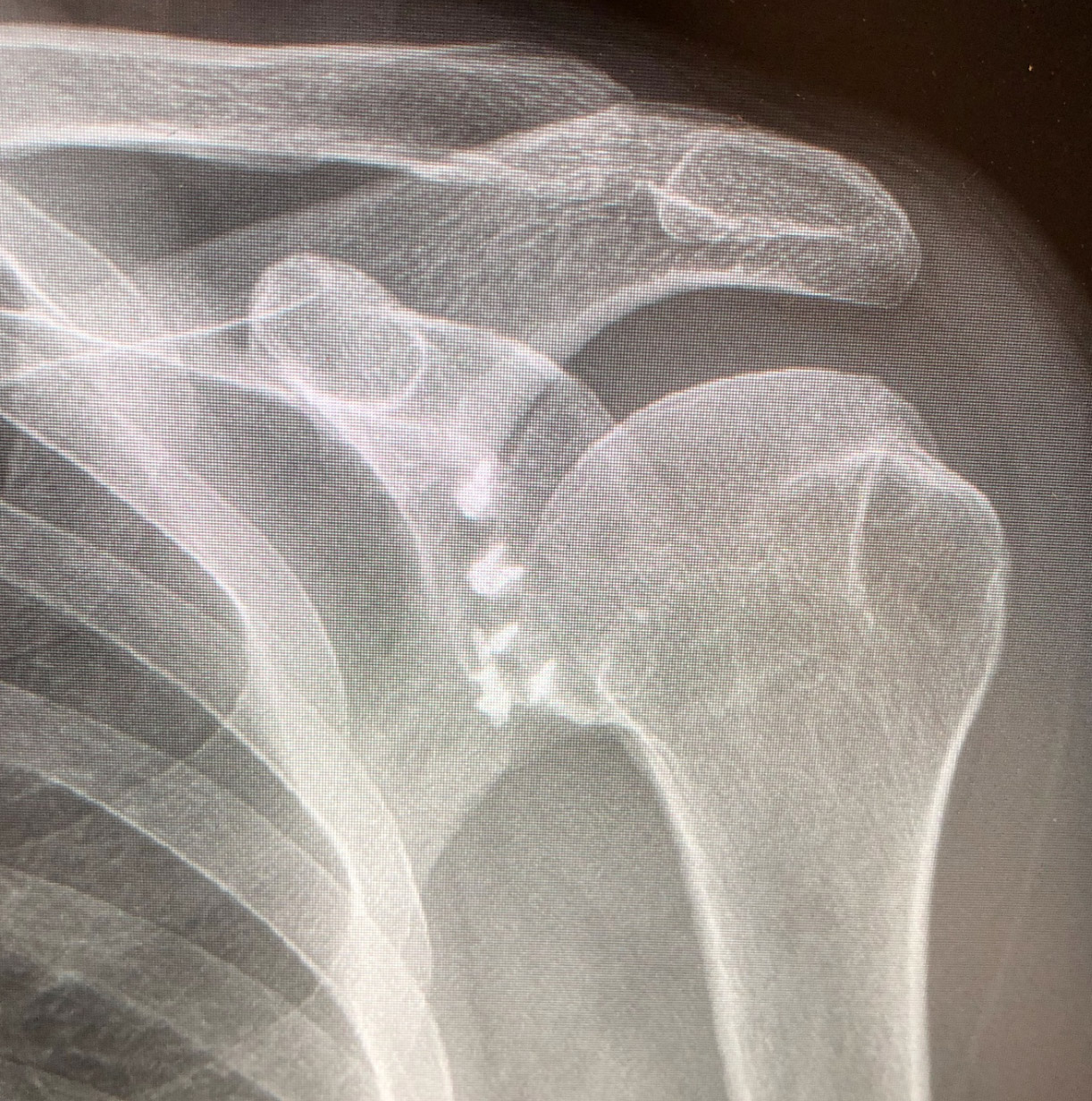 Acromioclavicular (AC) Joint Separations - Frisco, TX - Knee, Hip, Shoulder,  Joint Surgery