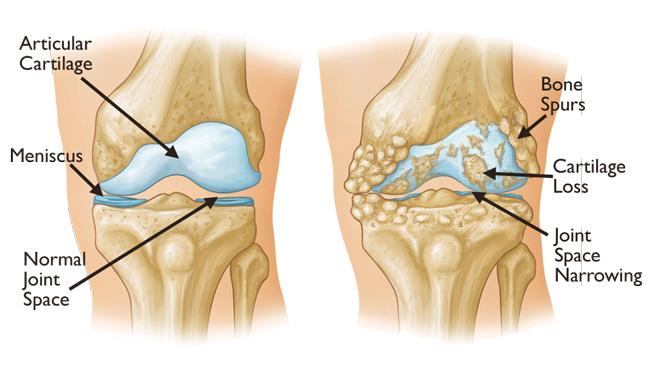 Iliotibial Band Syndrome (ITB Syndrome), Frisco, TX