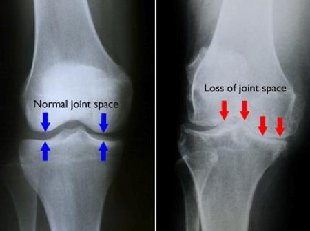 Knee Joint Space