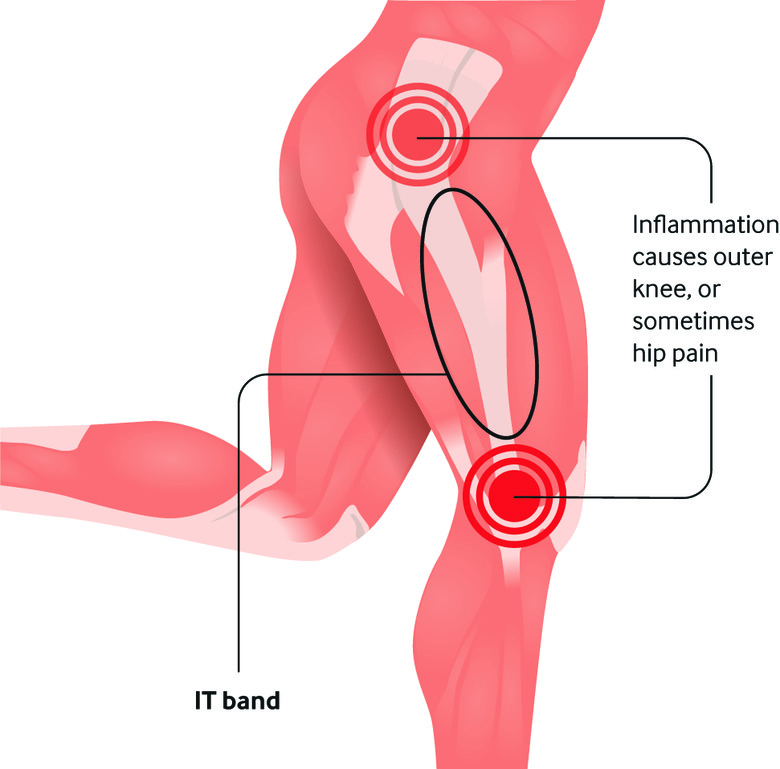 At Home IT Band Syndrome Physical Therapy
